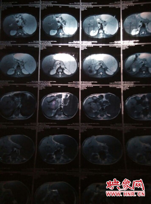 寧陵少年患病十幾年仍堅(jiān)持上學(xué) 無(wú)錢治病盼救助