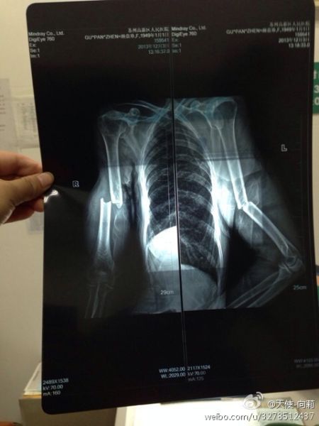 圖為微博上傳“范某某的妻子顧盤珍手被打斷。”