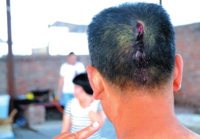 崔先生頭部受傷。京華時報記者趙思衡攝/視頻