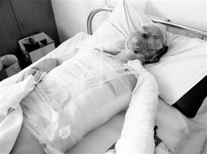 周小姐的頭、頸、軀干、四肢均被燒傷，其中面部燒傷最為嚴(yán)重。