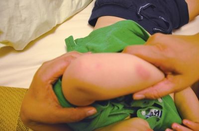 孩子身上有多處明顯傷痕。京華時報讀者供圖