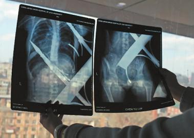 12歲女孩從6樓陽臺(tái)墜下 身體被樓下鐵柵欄刺穿