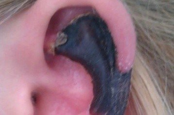 荷蘭女子旅游途中被蜘蛛咬，耳軟骨溶解變黑。