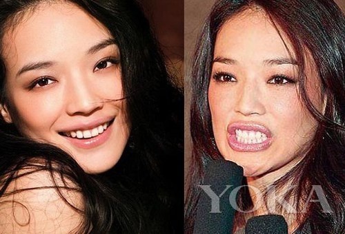 牙齒凸出，口輪肌過于松弛