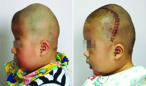 術(shù)前（左），術(shù)后（右）