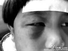 6月2日，網(wǎng)曝渭南市臨渭區(qū)一不滿5歲的女童遭奶奶毆打，眼圈青腫，引起網(wǎng)友關(guān)注，但孩子父母和爺爺均稱是摔倒導(dǎo)致。相關(guān)部門介入調(diào)查發(fā)現(xiàn)確為奶奶毆打所致，鑒于其身體原因已進行批評教育。