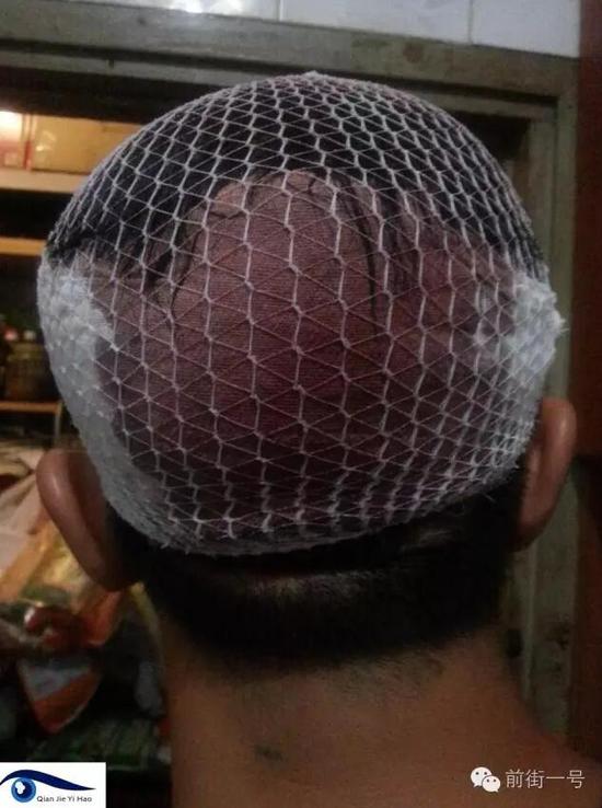 李律師受傷后縫合三針。