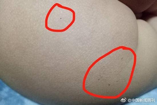 據(jù)多名紅黃藍(lán)(新天地分園)家長反映，孩子腿部、屁股、腋下出現(xiàn)針眼。