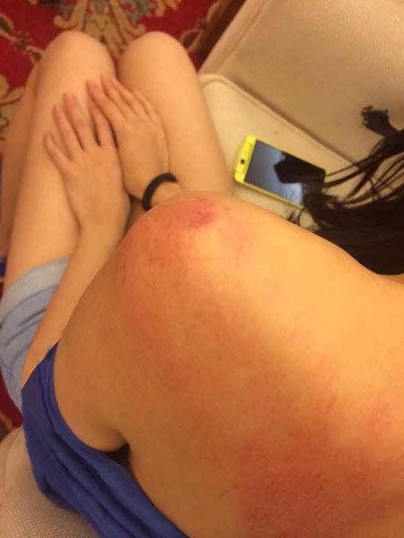 “跑男”真的很拼！baby朋友圈曬后背紅腫照