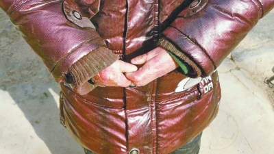 長期受損的手指，已經(jīng)長在了一起。