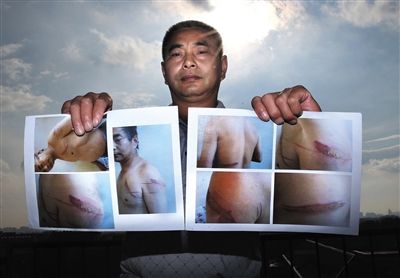 王維龍出示在張家口被關時被虐受傷的照片。