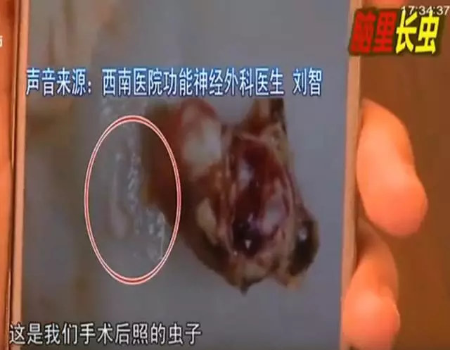 少女大腦皮層萎縮 醫(yī)生從她腦子里捉出5厘米蟲(chóng)子
