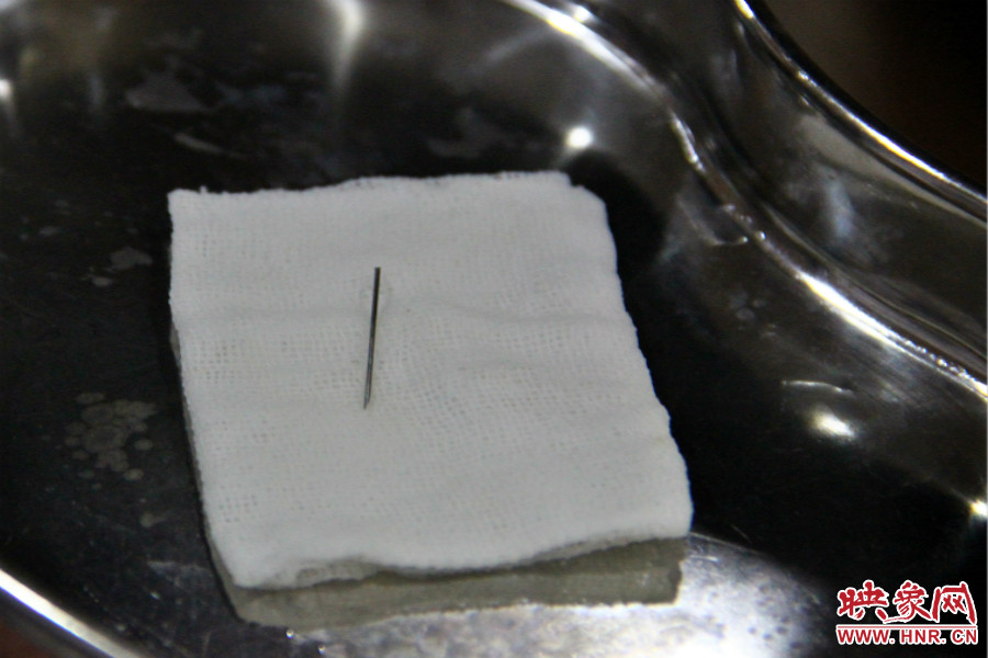 上午11點(diǎn)30分許，小龍腦中鋼針已經(jīng)成功取出。