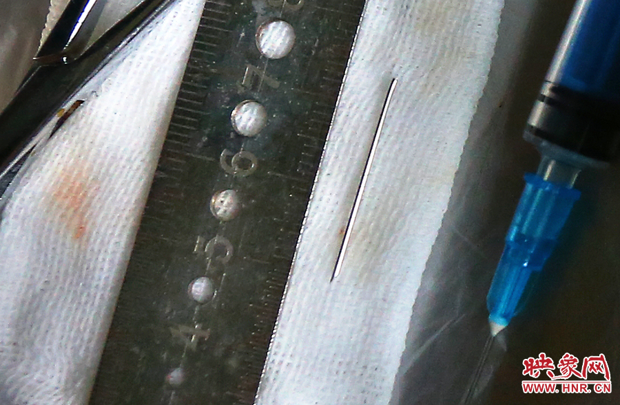 上午11點42分，大龍顱內(nèi)的鋼針被取出