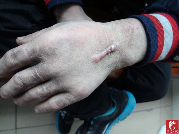 被發(fā)現(xiàn)男子手上的傷疤。