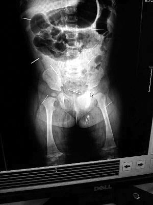 目前體內(nèi)的12根鋼針多分布在孩子的臀部，一根在腹部，其余3根在胸腔附近，其中一根很接近心臟