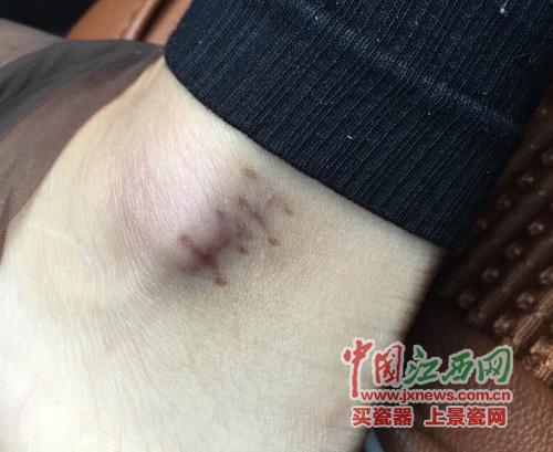 南昌一酒店玻璃門(mén)爆裂顧客多處割傷 店方拒賠償 南昌一酒店玻璃門(mén)爆裂顧客多處割傷 店方拒賠償