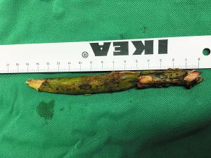 插入男子腦內(nèi)的樹枝。