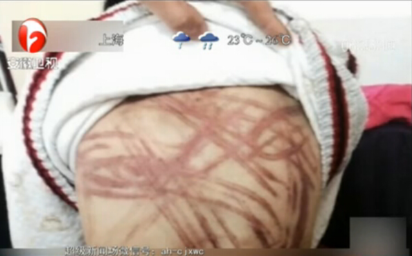 “虐童案”開(kāi)庭 養(yǎng)母堅(jiān)稱無(wú)罪