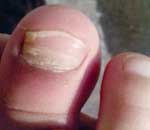 一幼兒園兒童“指甲異?！? title=